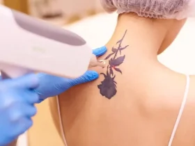 Laser Tattoo Removal