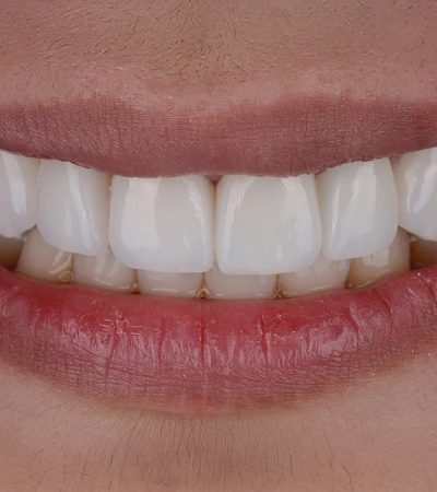 Can Porcelain Veneers Fix Gaps