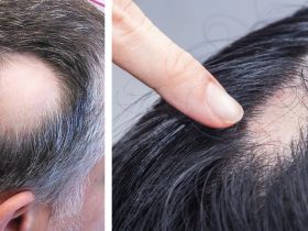 Alopecia Areata London
