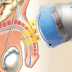 Shockwave Therapy for ED