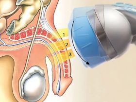 Shockwave Therapy for ED